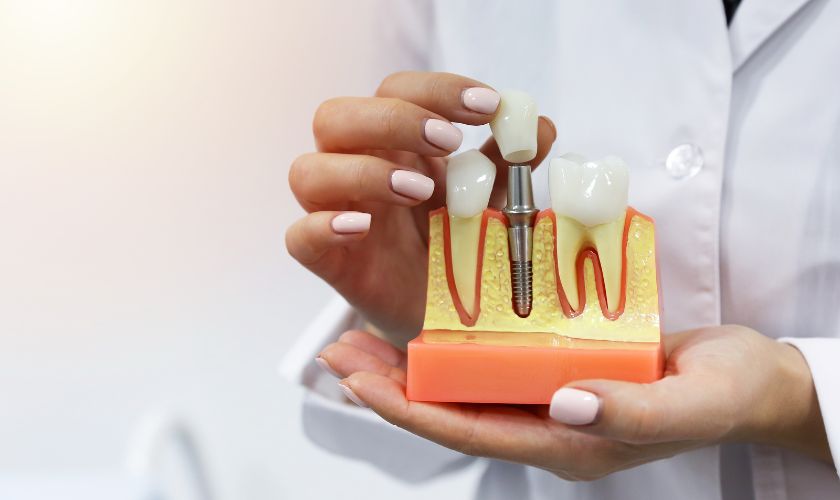 Dental Implants San Antonio, TX
