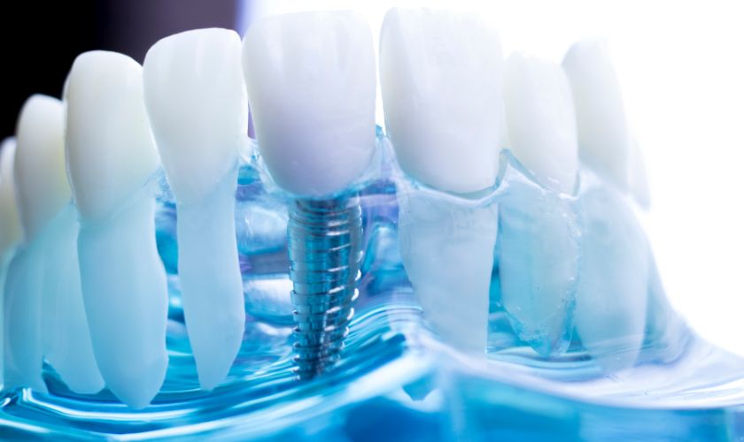 Dental Implants in San Antonio
