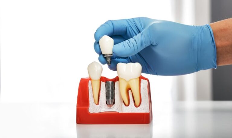 dental implant san antonio