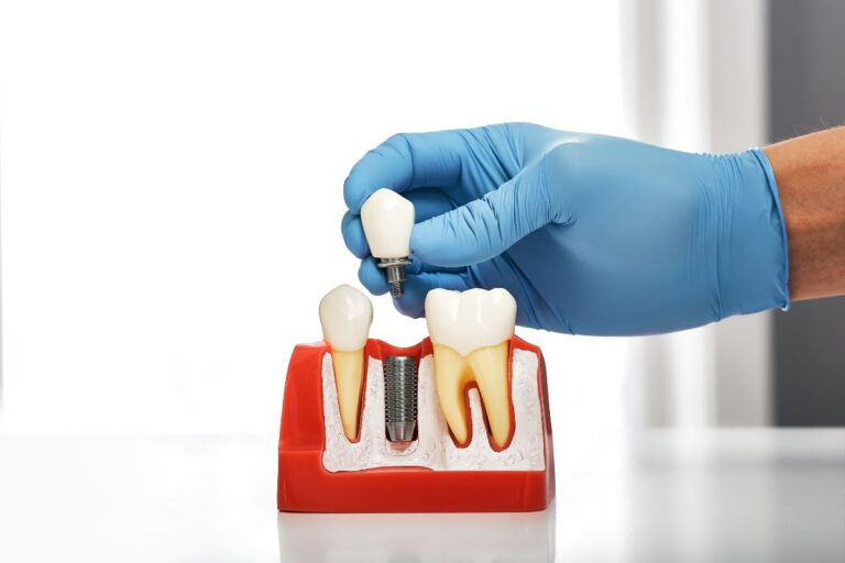 dental implants san antonio