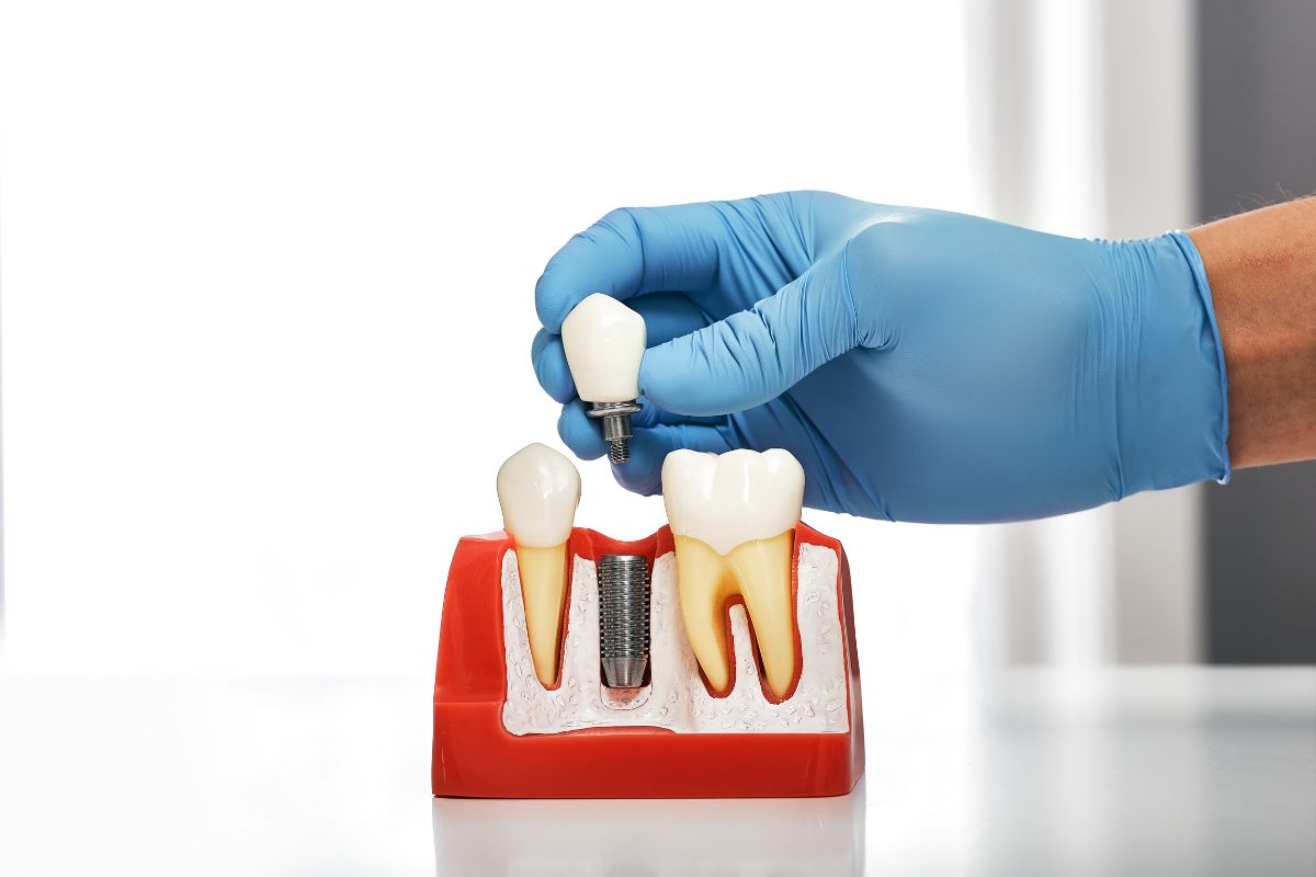 dental implants san antonio