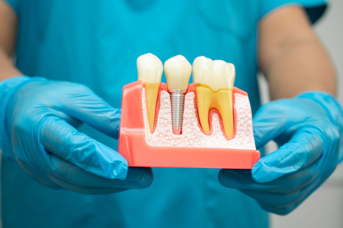 dental implants in san antonio