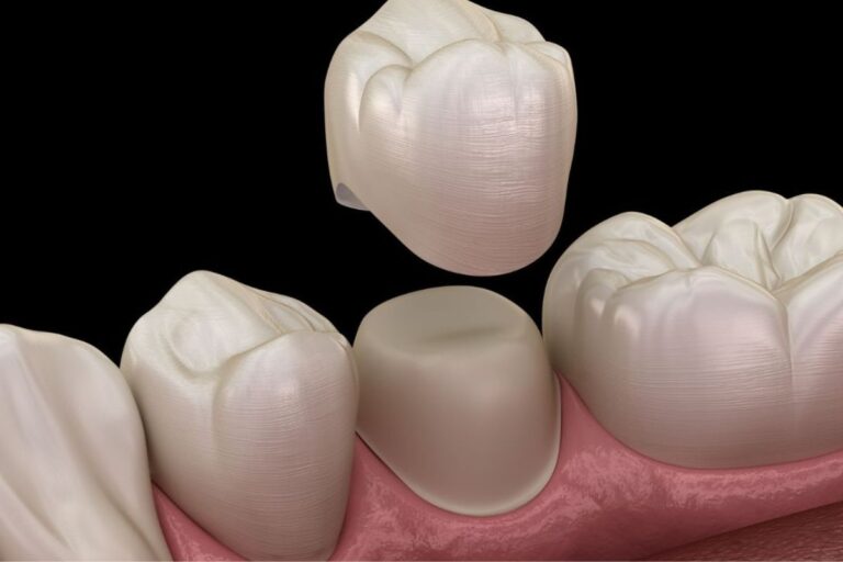 dental crowns san antonio