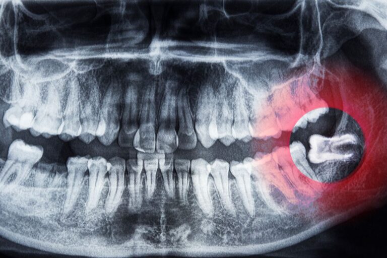 Dental X-ray showing impacted wisdom tooth in lower jaw
