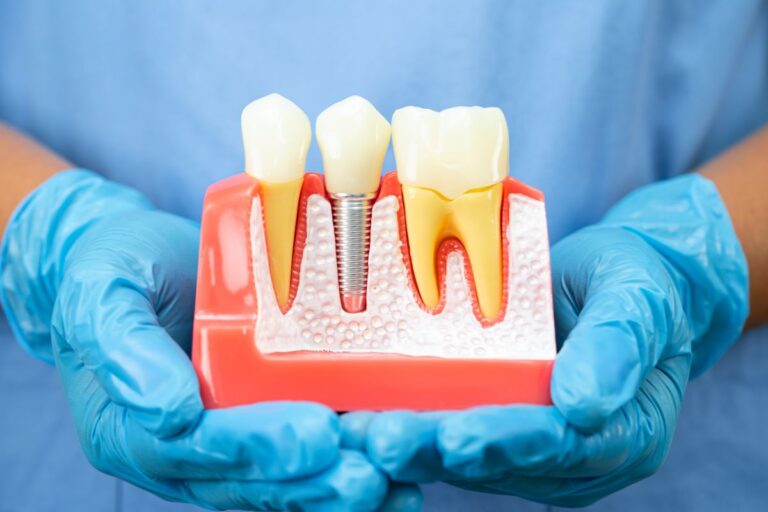 Tooth implant model demonstrating implant-supported tooth replacement