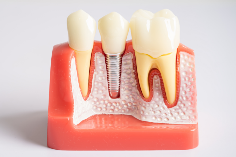 dental implants San Antonio