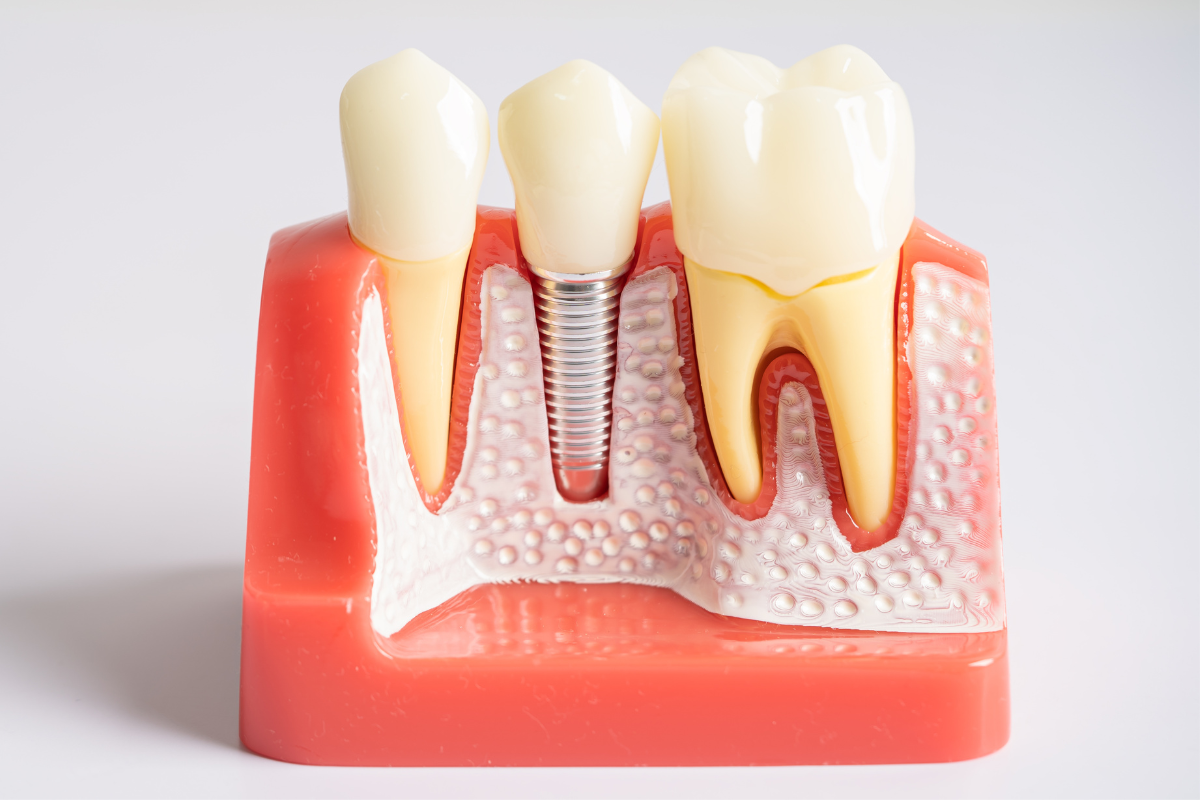 dental implants San Antonio