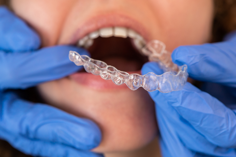 Invisalign in San Antonio