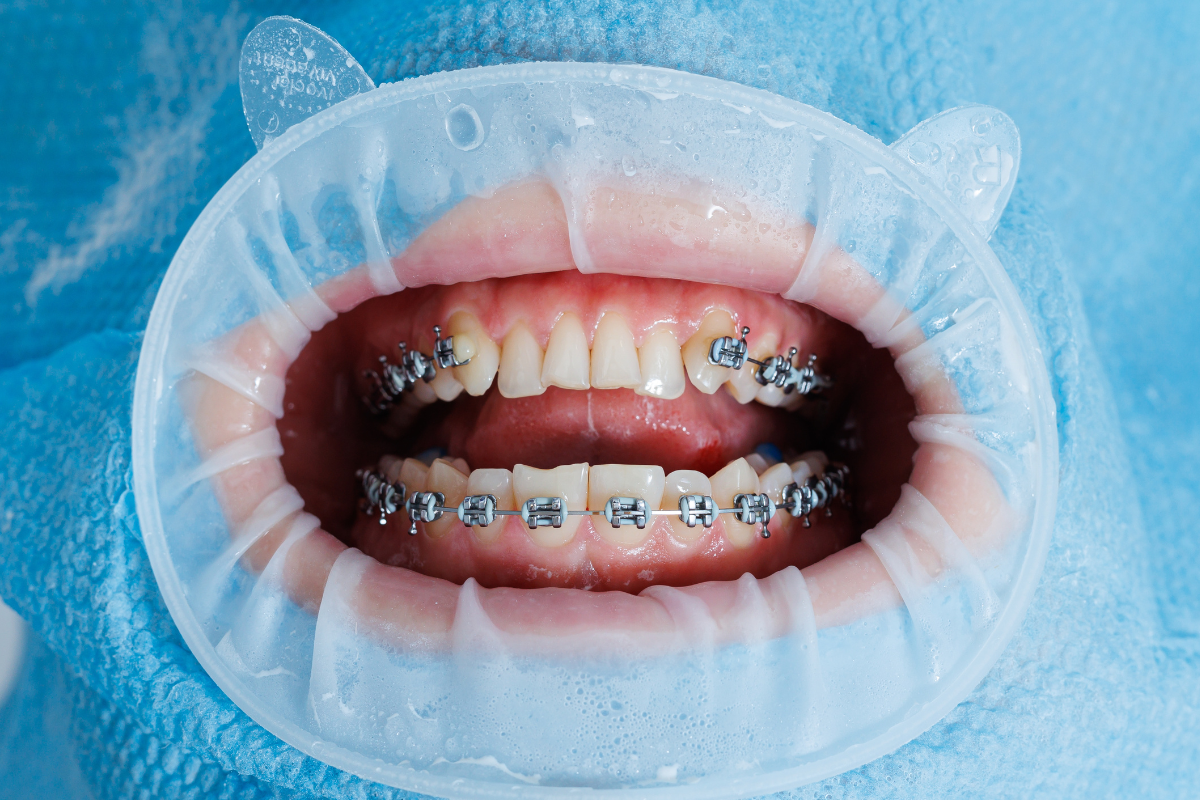 braces in San Antonio